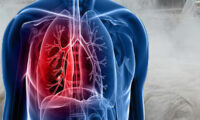 Know Everything About Different Types of Silicosis