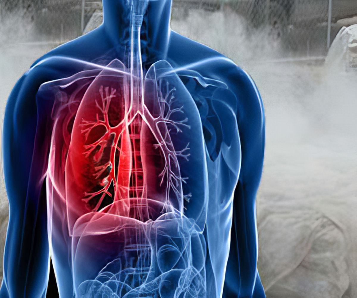 Know Everything About Silicosis