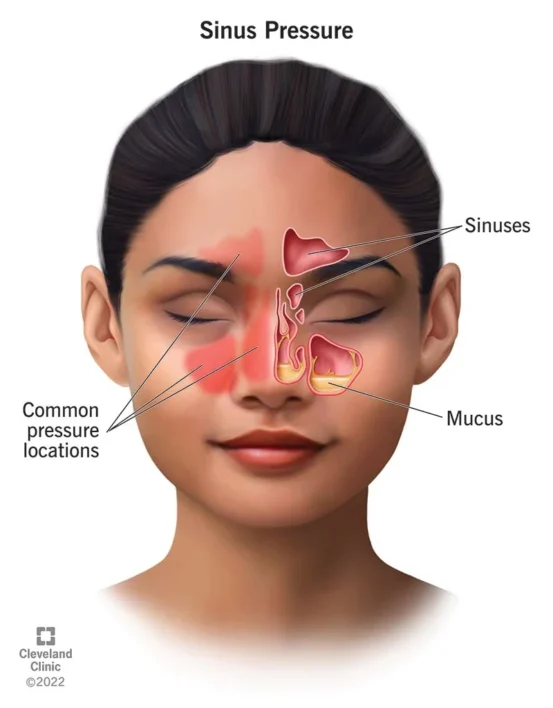 Sinus infection symptoms facial pain and pressure illustration