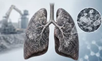 Types of Silicosis: Acute, Chronic & Accelerated Forms Explained